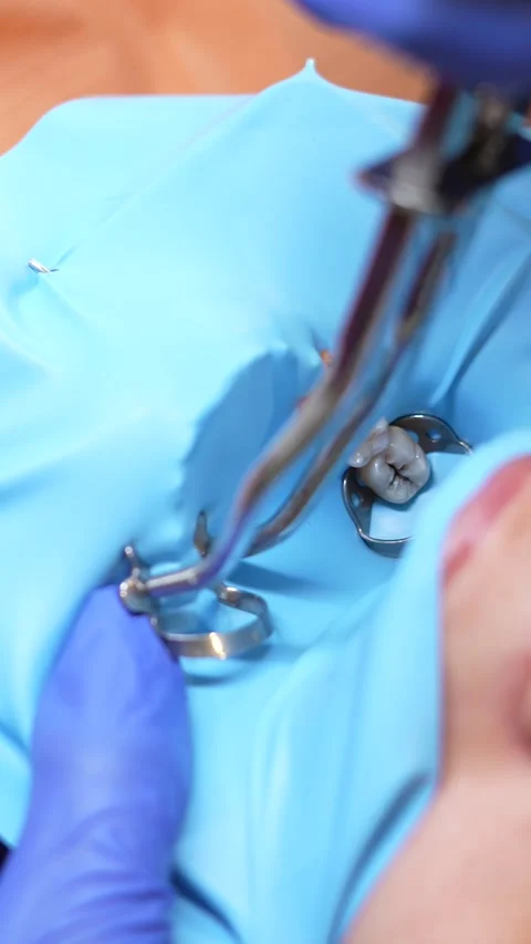 Dental Tool Usage Stock Footage 316915001