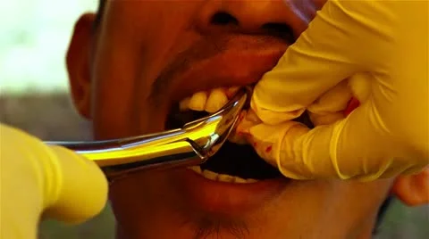 Dental tooth extraction Stock-Footage 21154067