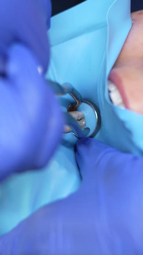 Dental Tooth Extraction Process Stock Footage 316914812