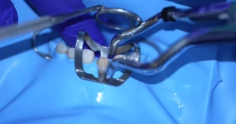 Dental Treatment in Action Stock Footage 316916640