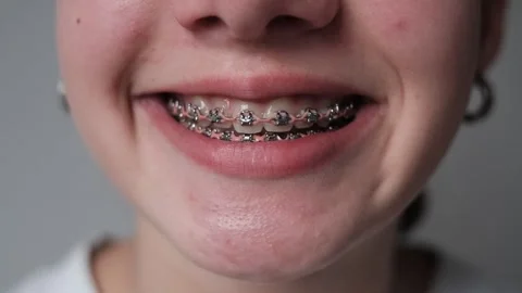 Dental treatment with a bracket system 스톡 동영상 307441608