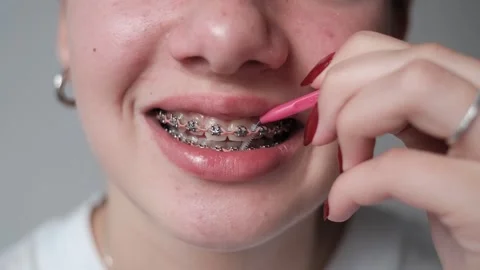 Dental treatment with a bracket system Stock Footage 307441727