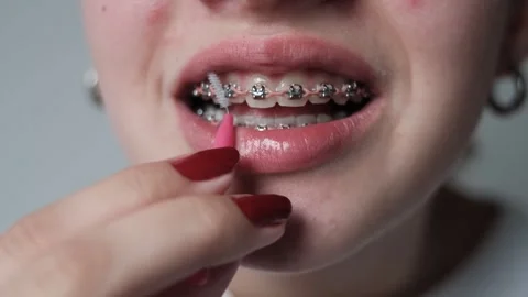 Dental treatment with a bracket system Stock Footage 307441730