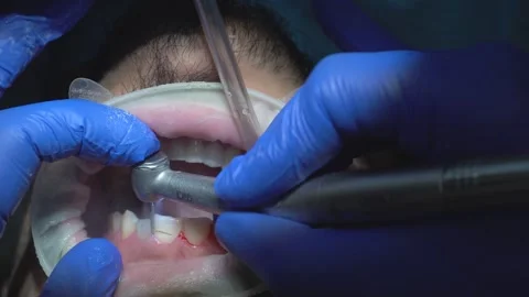 Dental Treatment Close-Up Stock Footage 316913448