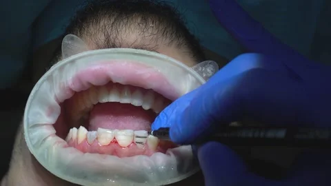 Dental Treatment in Progress Stock Footage 316913397