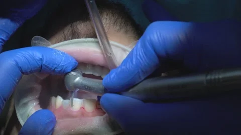 Dental Treatment in Progress Stock Footage 316913487