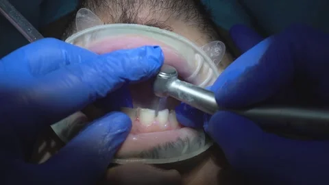 Dental Treatment in Progress Stock Footage 316913685