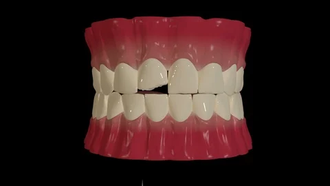 Dental Veneers Placement 스톡 동영상 126814651