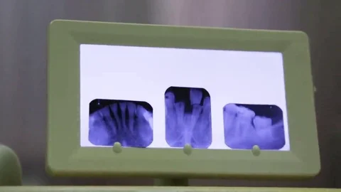 Dental X-ray analysis Stock Footage 69220015