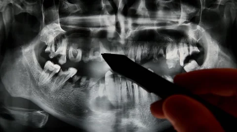 Dental x ray with bad teeth Stock Footage 48510249