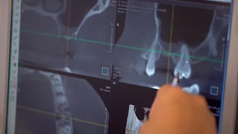 Dental X ray with bad teeth. dentist examining x-ray report on computer in Stock Footage 86963764