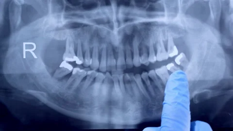 Dental x-ray 스톡 동영상 163511128