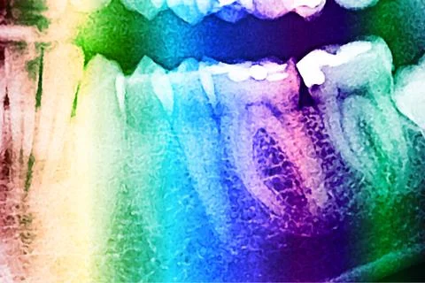Dental X-Ray Of Human Teeth Stock Illustration