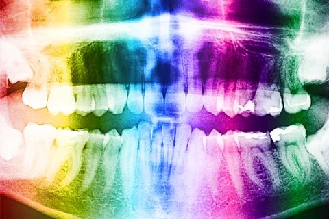 Dental X-Ray Of Human Teeth Stock Illustration