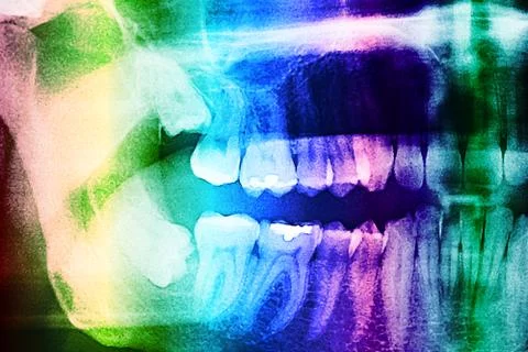 Dental X-Ray Of Human Teeth Stock Illustration