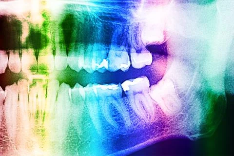 Dental X-Ray Of Human Teeth Stock Illustration