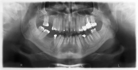 Dental x-ray Stock Photos