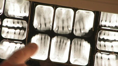 DENTAL X-RAYS Stock Footage 555289