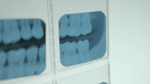 Dental X-rays Video stock 90583154