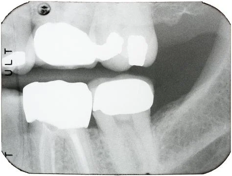 Dental X-rays of teeth in the back of the mouth Foto stock