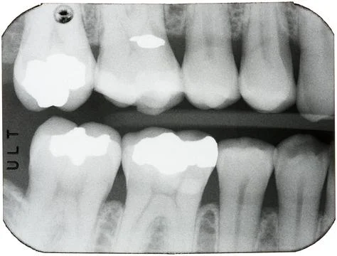 Dental X-rays of teeth in the back of the mouth Foto stock