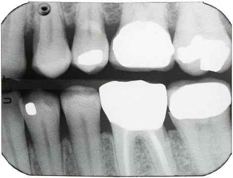Dental X-rays of teeth in the back of the mouth Foto stock