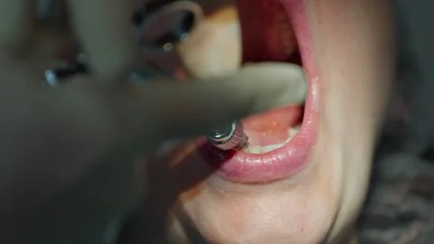 Dentist administering anesthesia with a syringe before starting a dental implant Stock Footage 342079958