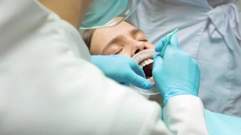 Dentist applying adhesive to patients teeth before aligner placement during.. Stock Footage 305500501