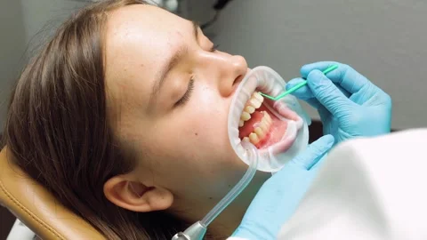 Dentist applying adhesive to patients teeth before aligner placement during.. Stock Footage 305500523