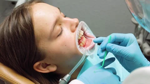 Dentist applying adhesive to patients teeth before aligner placement during.. Stock Footage 305500546