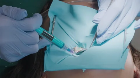 Dentist applying blue acid etchant gel to tooth enamel from dental syringe Видео 331239638