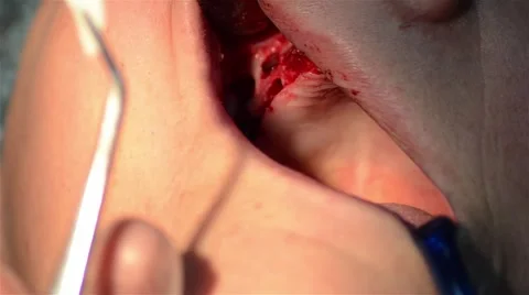 Dentist applying a dressing with antibiotic after making a jaw implant surgery Stock Footage 60798611