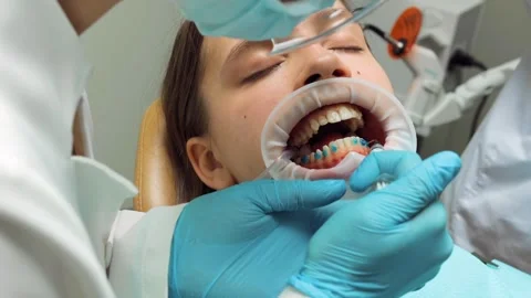Dentist applying etching gel to patients enamel during aligner preparation .. Stock Footage 305500475