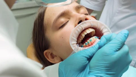 Dentist applying etching gel to patients enamel during aligner preparation .. Stock Footage 305500477
