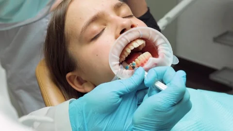 Dentist applying etching gel to patients enamel during aligner preparation .. Stock Footage 305500491