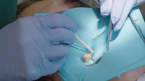 Dentist applying liquid adhesive bond inside tooth cavity with microbrush Video stock 331239523