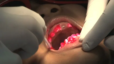 Dentist Applying Red Stain To Check Boys Teeth 스톡 동영상 32376816