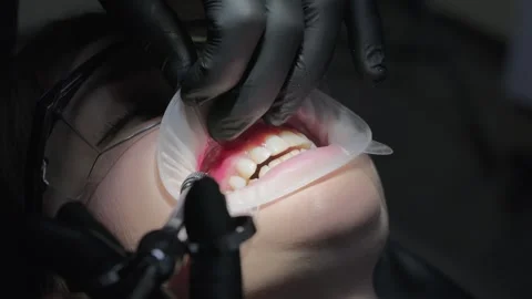 Dentist in black gloves carefully applying a red anesthetic or treatment gel to Stock Footage 339274193