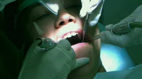 Dentist Buffering Molars 스톡 동영상 144015