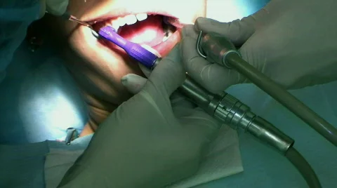 Dentist Buffering Teeth 库存影片 144038