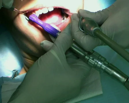 Dentist Buffering Teeth 库存影片 144045