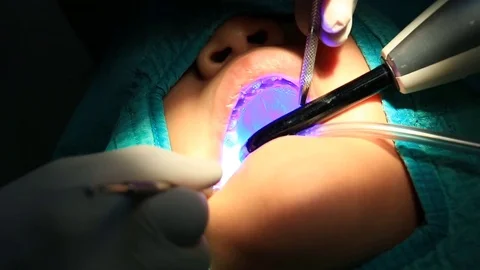 Dentist Checking And Treating Tooth Decay (handheld shot) Stock Footage 75989087