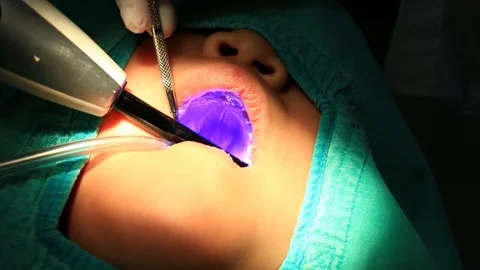 Dentist Checking And Treating Tooth Decay (handheld shot) Stock Footage 75989439