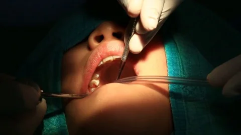 Dentist Checking And Treating Tooth Decay (handheld shot) Stock Footage 75991250