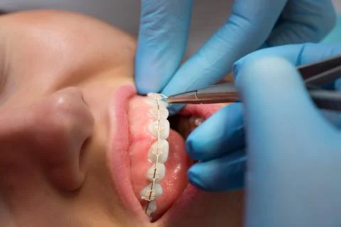 Dentist checking bracket at the braces on the female patient. Close-up. Real  Stock Photos