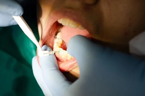 Dentist checking up teeth with ceramic brackets using dental tools. Foto stock