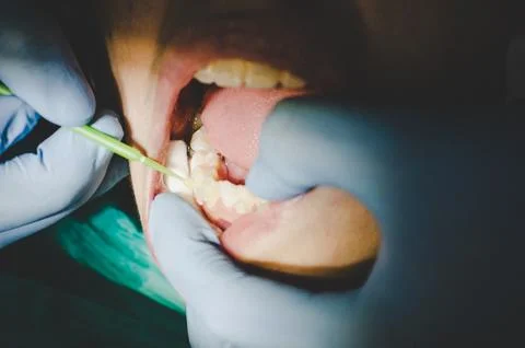 Dentist checking up teeth with ceramic brackets using dental tools. 写真素材