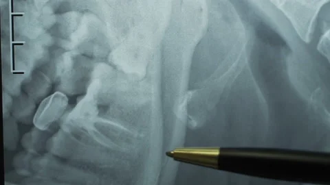 Dentist Checking X Ray Of Patient Teeth On Digital Screen Stock Footage 99383172