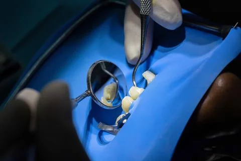 Dentist cleaning root canal under rubber dam isolation Stock Photos