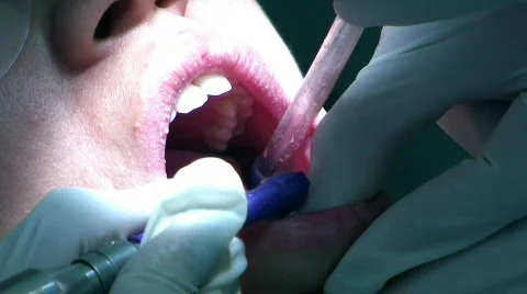 Dentist Cleaning Teeth 5 库存影片 144307